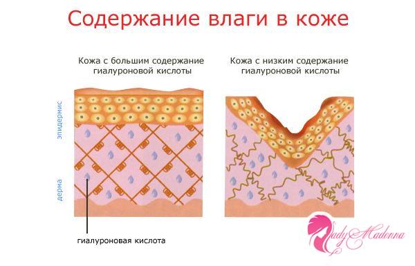 Гиалуроновая кислота