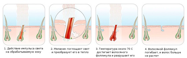 Принцип действия фотоэпилятора